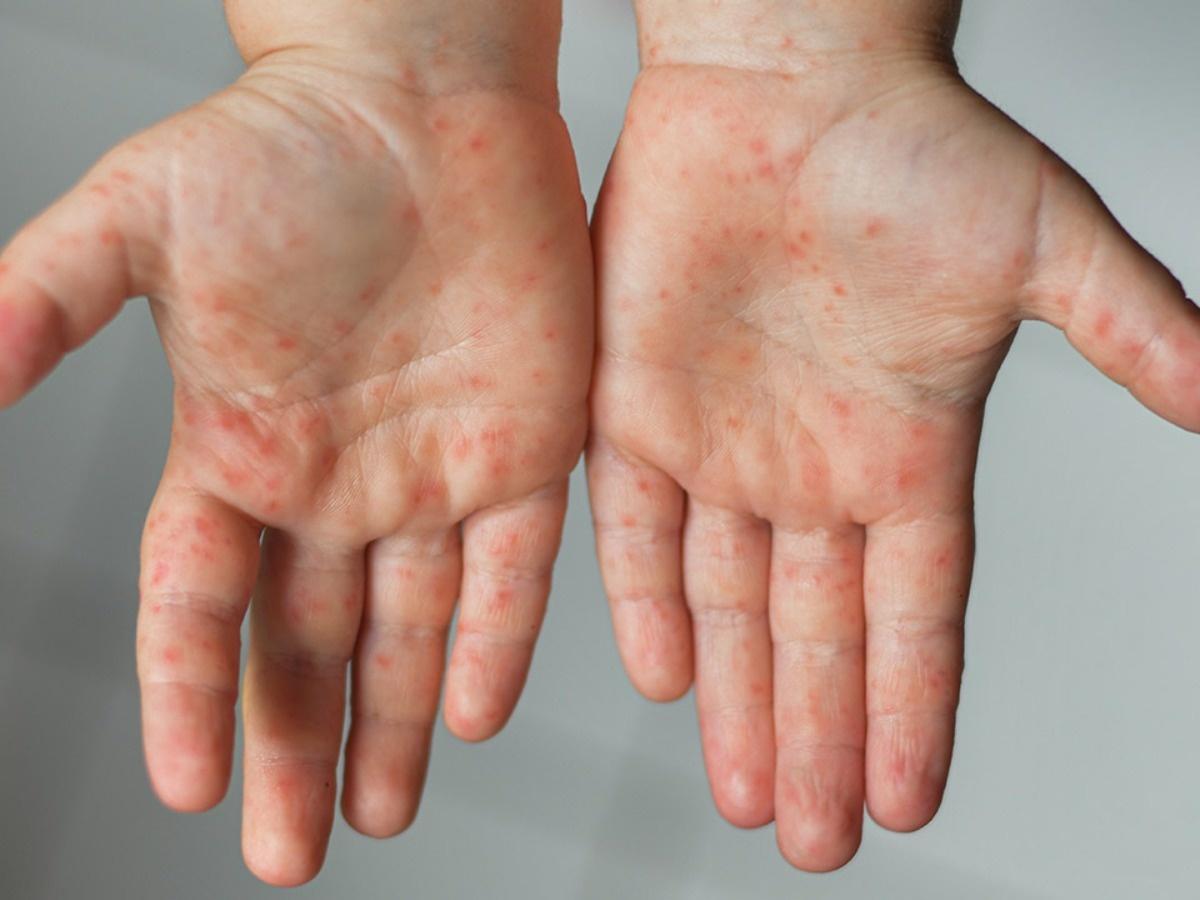 Amid Rising Monkeypox Cases, Hand, Foot, And Mouth Disease ...