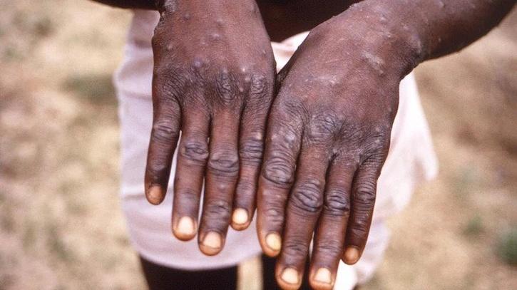 Monkeypox adalah zoonosis virus dengan gejala yang mirip dengan yang terlihat di masa lalu pada pasien cacar.