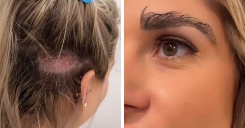 Woman Gets Eyebrow Transplant From Hair On Her Head