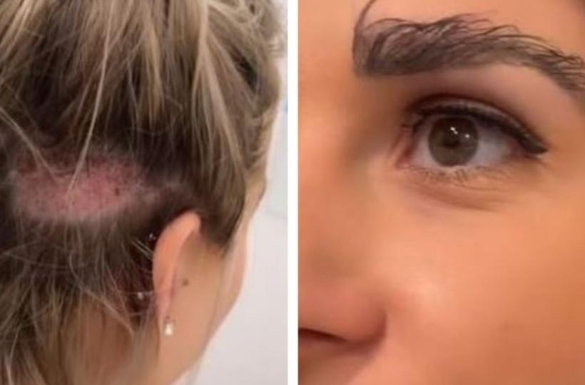 Woman Gets Eyebrow Transplant From Hair On Her Head