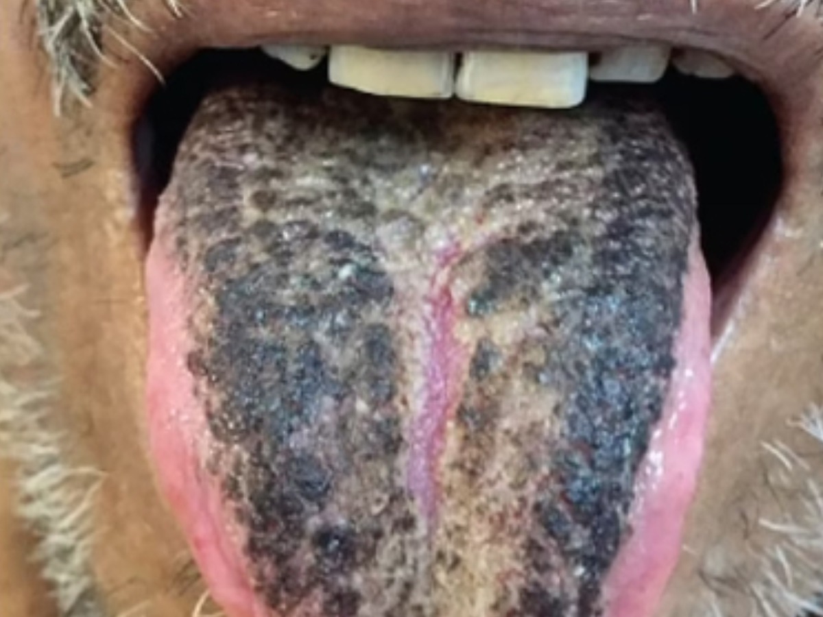 Kerala Man's Tongue Turns Black And 'Hairy' After Stroke