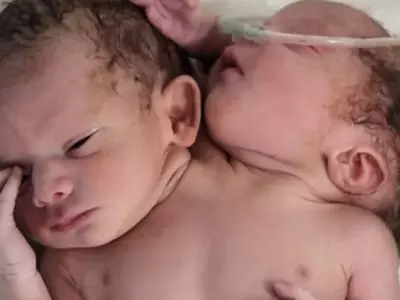 baby with two heads
