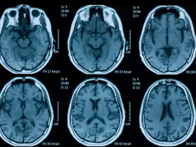 Distinct Changes In Brain Found In Astronauts Even Months After Their Return to Earth