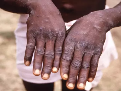 Sudden Appearance Of Monkeypox In Non-endemic Countries Suggests Undetected Transmission, Says WHO