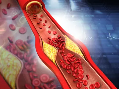 Good Cholesterol Might Not Be Good For All, Finds Study