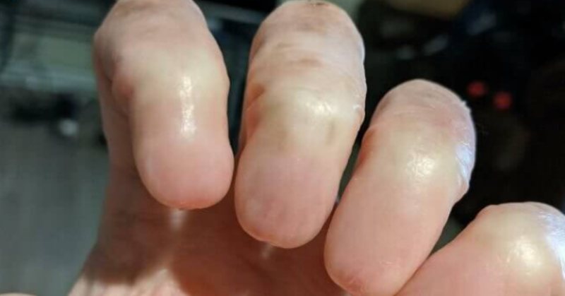 Image Of Hand Without Nails Shocks The Internet