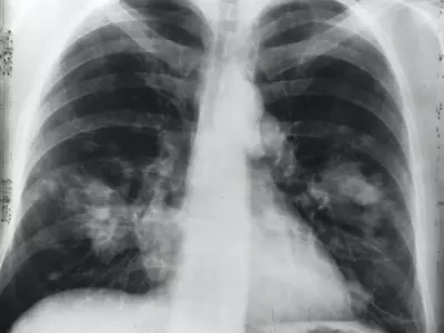 New Robotic Technology Detects, Treats Lung Cancer Before It Becomes Deadly