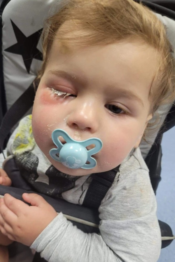 Nursery Worker Squirts Glue Into Toddler's Eye As She Fixes Nails