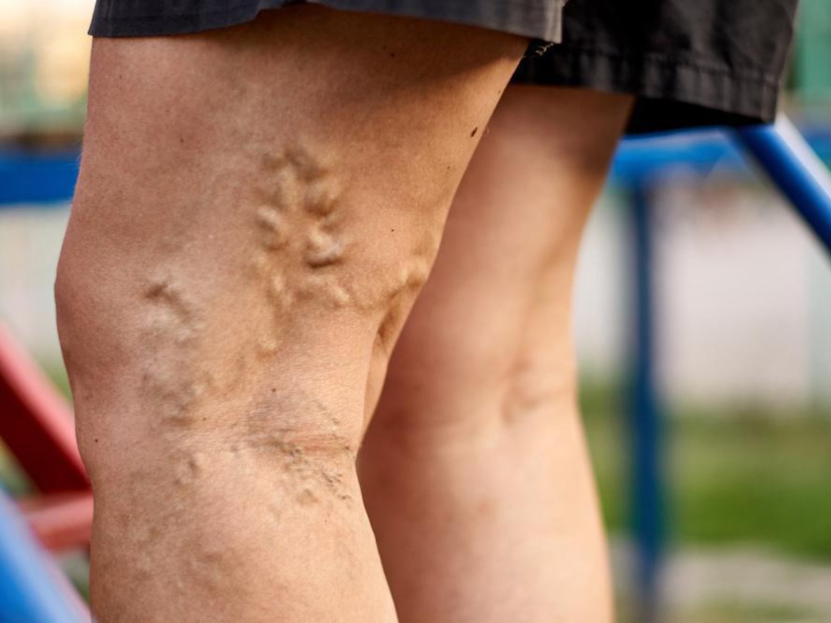 Sclerotherapy for Leg Veins  Contour Dermatology