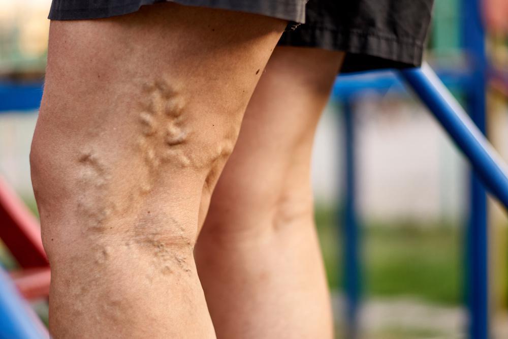 everything-you-need-to-know-about-varicose-veins-causes-and-treatment