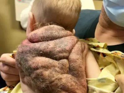 Boy Born With Shell On Back