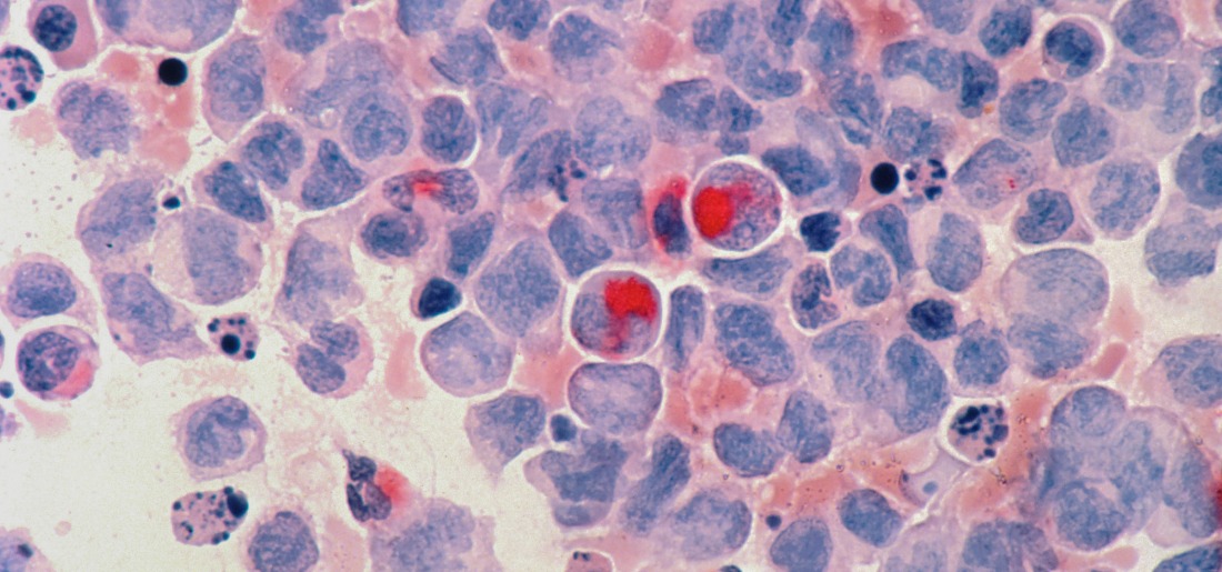 Researchers Use Sound Waves To Target And Destroy Cancer Tumours