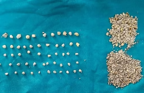 chennai doctors remove 1200 gallstones from patient 