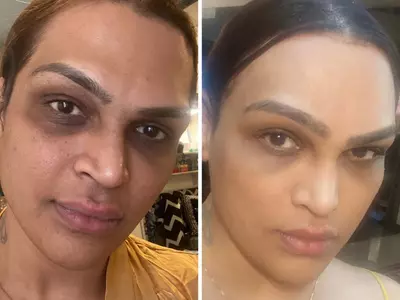 ‘I Want To Be Free And Happy’: Saisha Shinde Shares Before And After Pics Of Her Face Surgery
