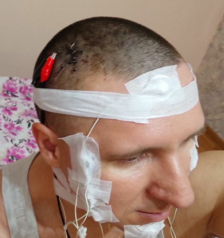 Russian man drills skull to insert chip into brain