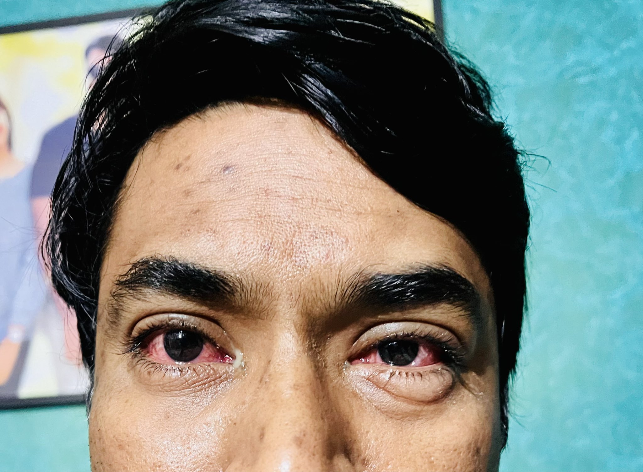Conjunctivitis Spreading Rapidly In Arunachal A Guide To Prevent This