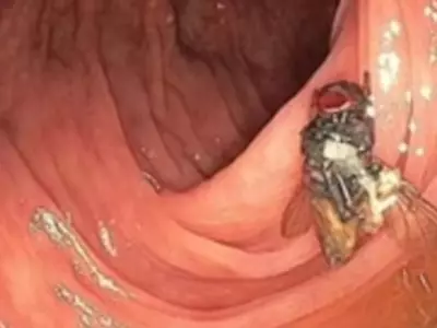 Doctors Detect Live Fly Living In Patient's Intestines