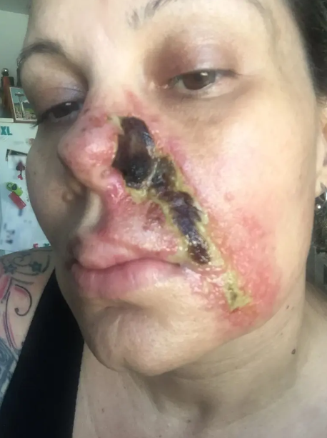 Facial filler melts woman's nose