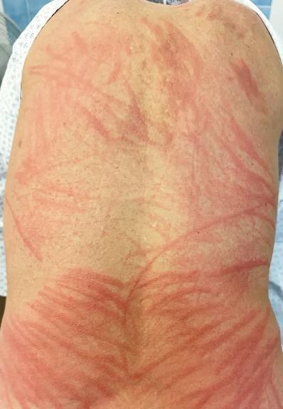 A man developed a rash that looked like something had scratched