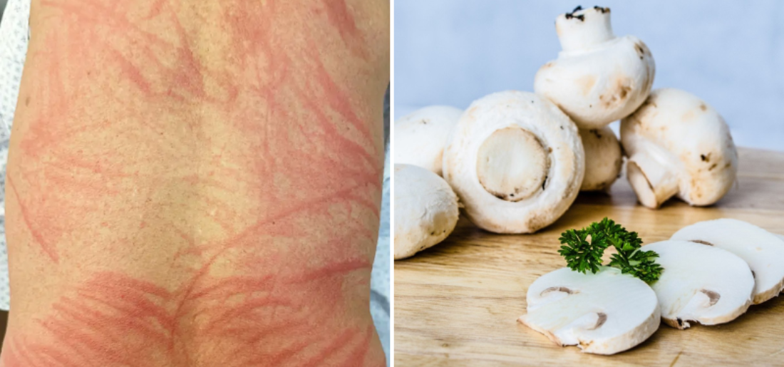 Rare 'Shiitake Rash' Develops In Man After Eating Undercooked Mushrooms