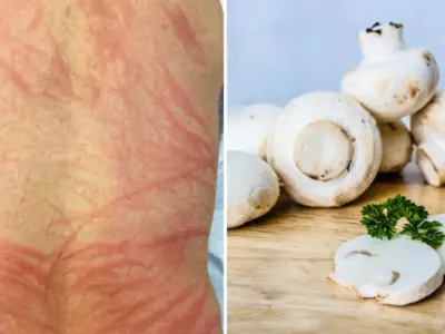 Undercooked Mushrooms Cause Rare Shiitake Rash In Man