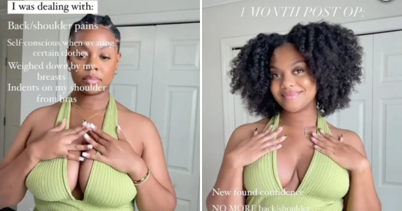 Why Gen Z Women Are Getting Breast Reduction Surgery And Sharing Their  Stories Online