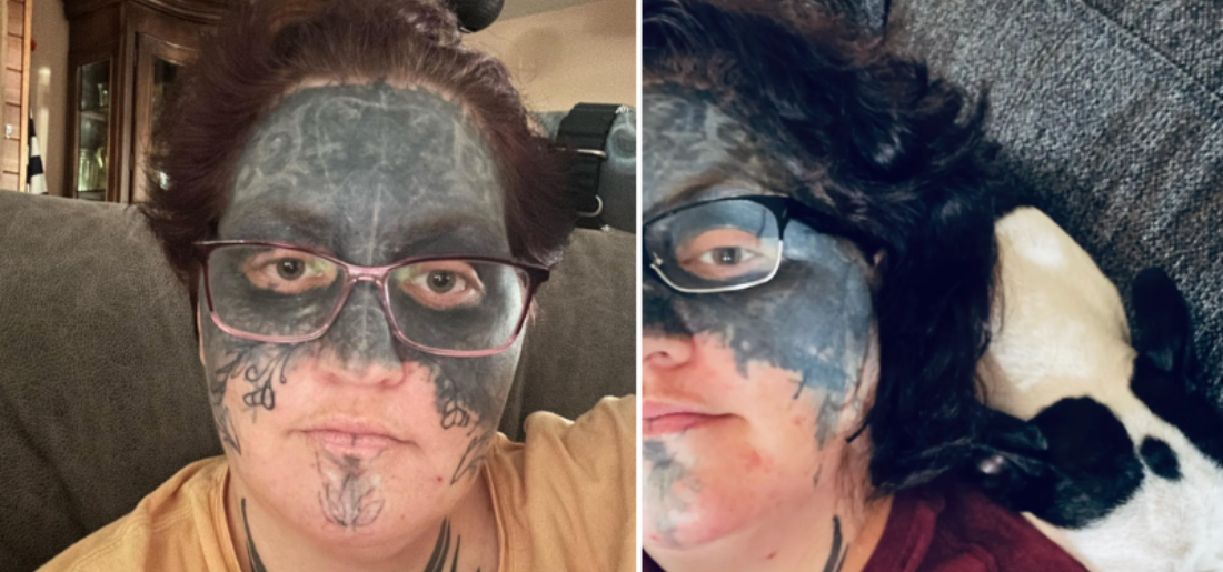 Woman With Full Face Tattoos Getting Them Removed 4982