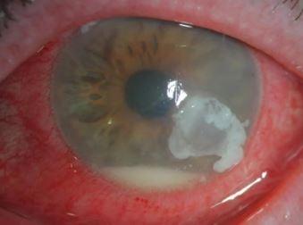 Beware Contact Lens Users! Woman Almost Lost Eyesight After Contact ...