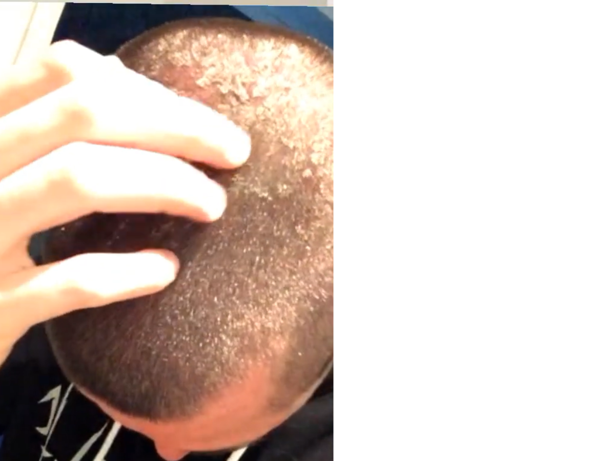 itchy scalp 