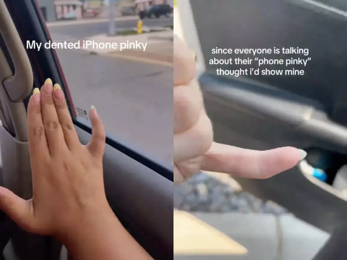 Gen Z¡¯s pinky finger is crooked from phone overuse: All about the 'phone pinky' syndrome Indiatimes