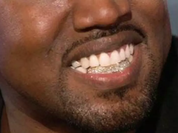 Kanye West Gives His Teeth A Titanium Makeover That Reportedly Costs