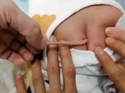 Chinese Baby Born With A Tail, Doctors Left Puzzled 