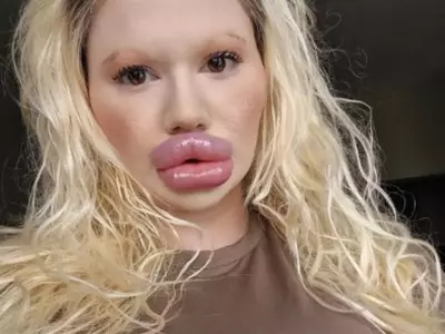 Woman Can't Find A Partner After Undergoing Four Lip Augmentation Surgeries