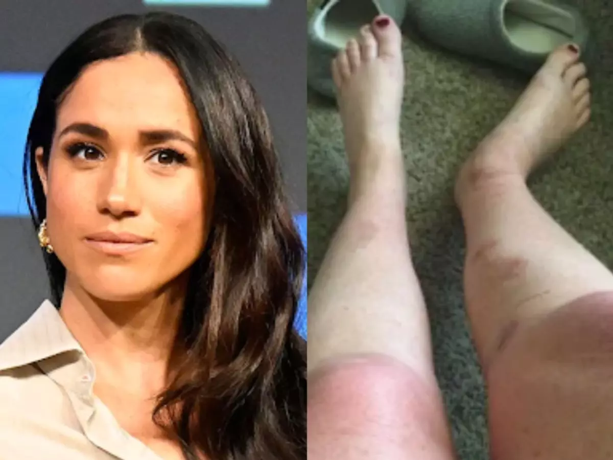 Meghan Markle fan threatens $10M lawsuit after burns from DIY bath salt recipe shown in her show; here's what we know Indiatimes