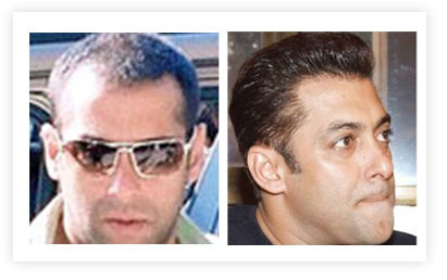 Salman Khans Hair Transplant Procedure in Dubai UAE