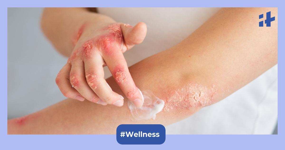 Winter skin woes: 6 things to do for preventing psoriasis flare-ups in cold weather