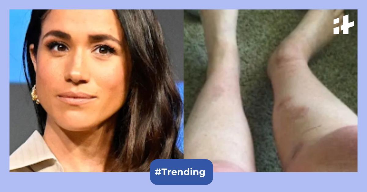 Meghan Markle fan threatens $10M lawsuit after burns from DIY bath salt