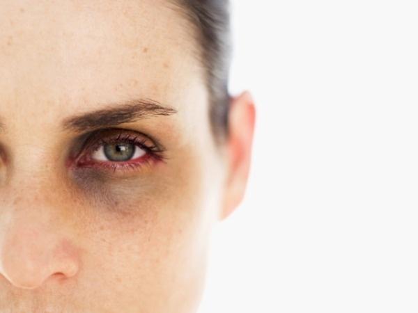 Why Do You Get Dark Circles Around Eyes When Pregnant? | LEAFtv