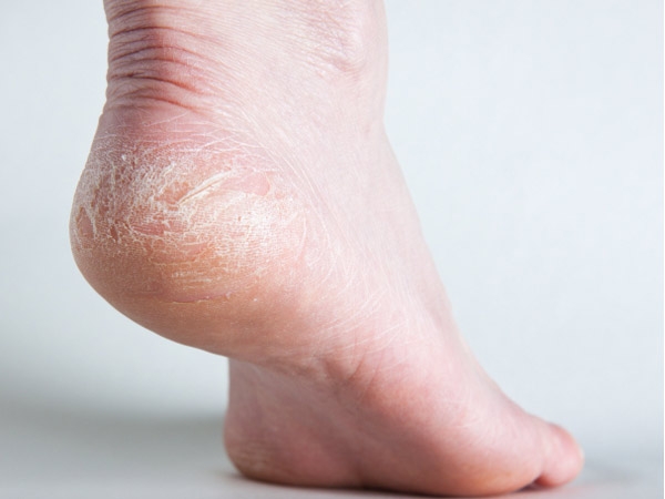 Learn How To Heal Dry, Cracked Feet Fast - Art of Skin Care