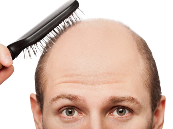 12 tips for solving male hair loss  newscomau  Australias leading news  site