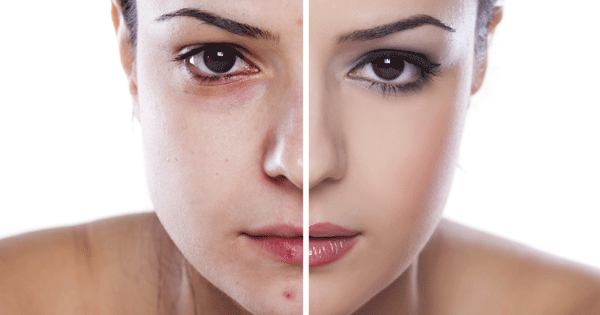 13 Natural Secret Ways To Get Rid of Acne Forever!
