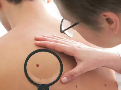 Skin Cancer Risks