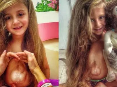 Meet This 6 YO Miracle Survivor, Who Has A Heart Growing Outside Her Chest!
