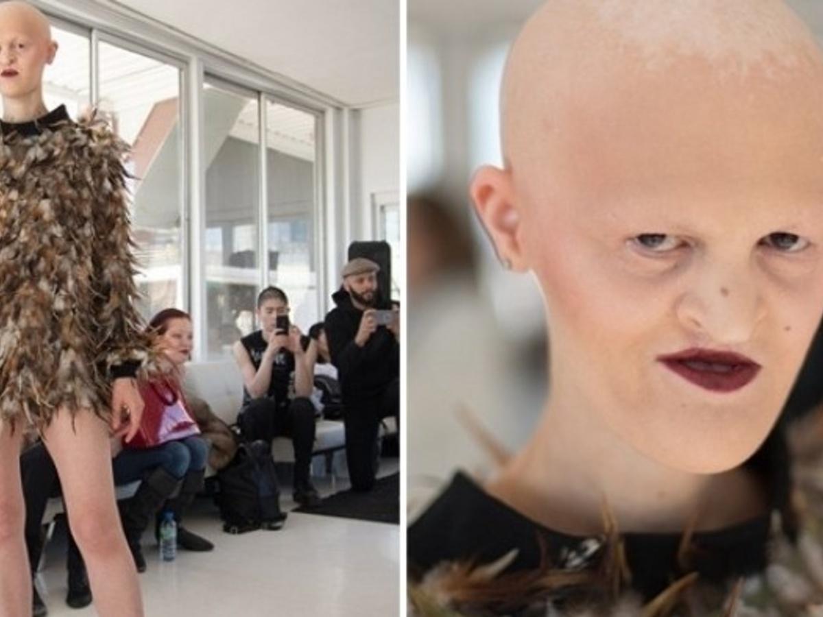 A Toothless And Bald Top Model Teaches The World The True Definition Of  'Beauty'