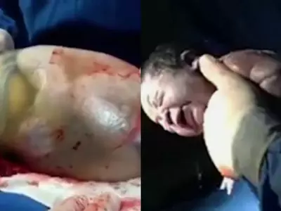 baby born in amniotic sac