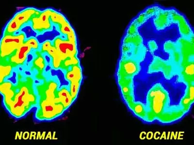 Cocaine Brain Damage