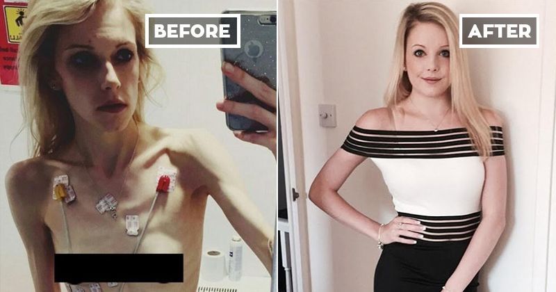 anorexia nervosa pictures before and after