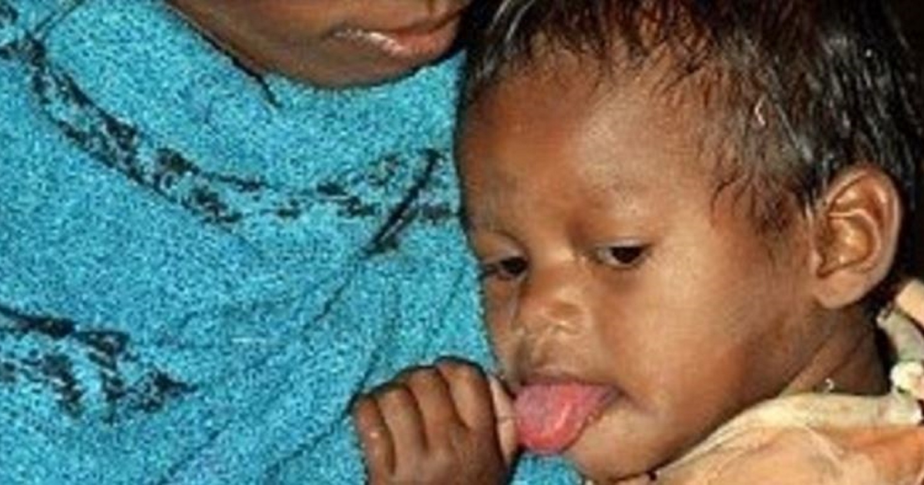 This Toddler Suffers From A Rare Condition Where Her Tongue Keeps