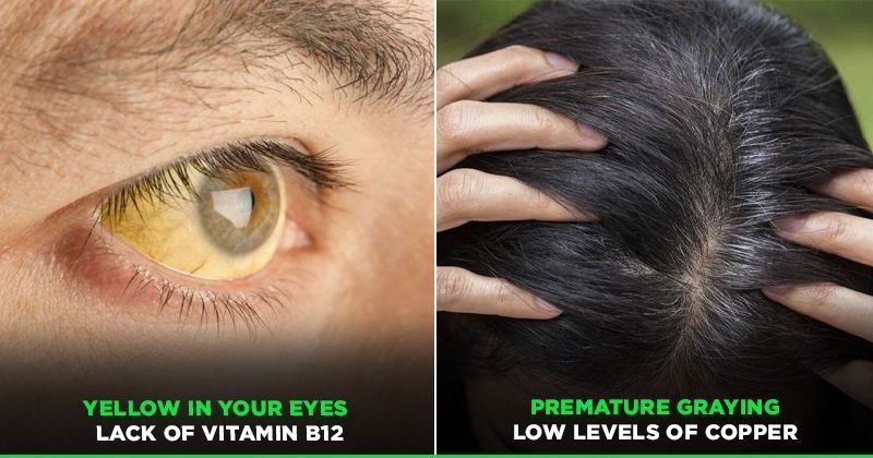 9 Signs From Your Body Which Indicate That You Re Deficient In Vitamins