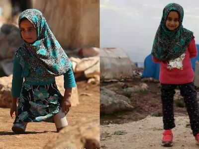 Eight-Year-Old Syrian Girl Who Wore Tin Cans & Plastic Tubes For Legs Now Walks On Prosthetics